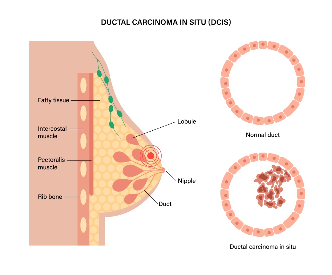 Ductal Carcinoma Breast Cancer Illustration 