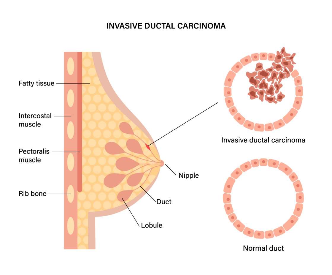 Invasive Ductal Carcinoma Breast Cancer illustration