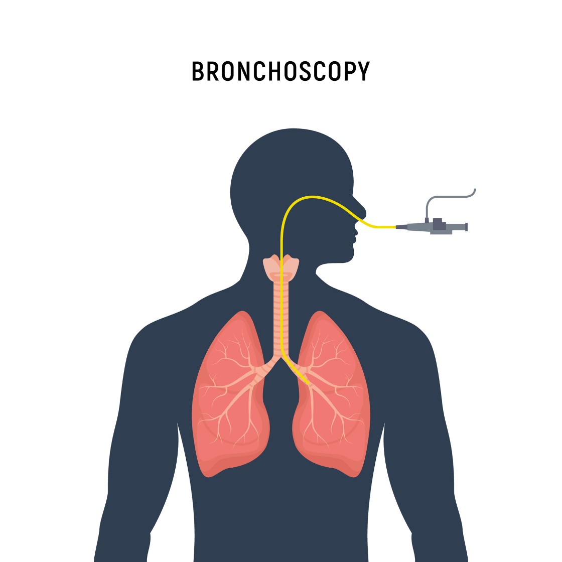 Robotic bronchoscopy minimally invasive procedure