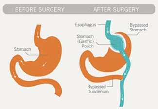 gastric bypass illustration