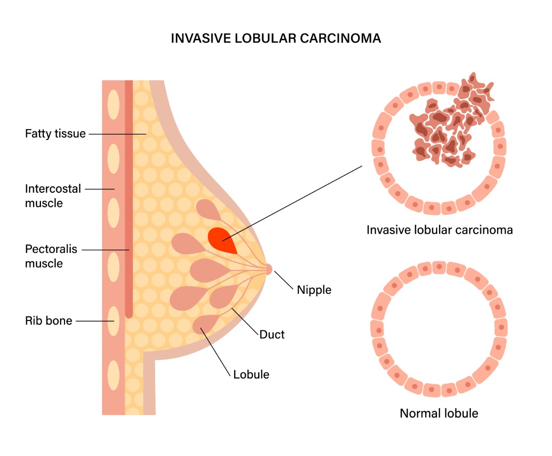 invasive lobular breast cancer illustration