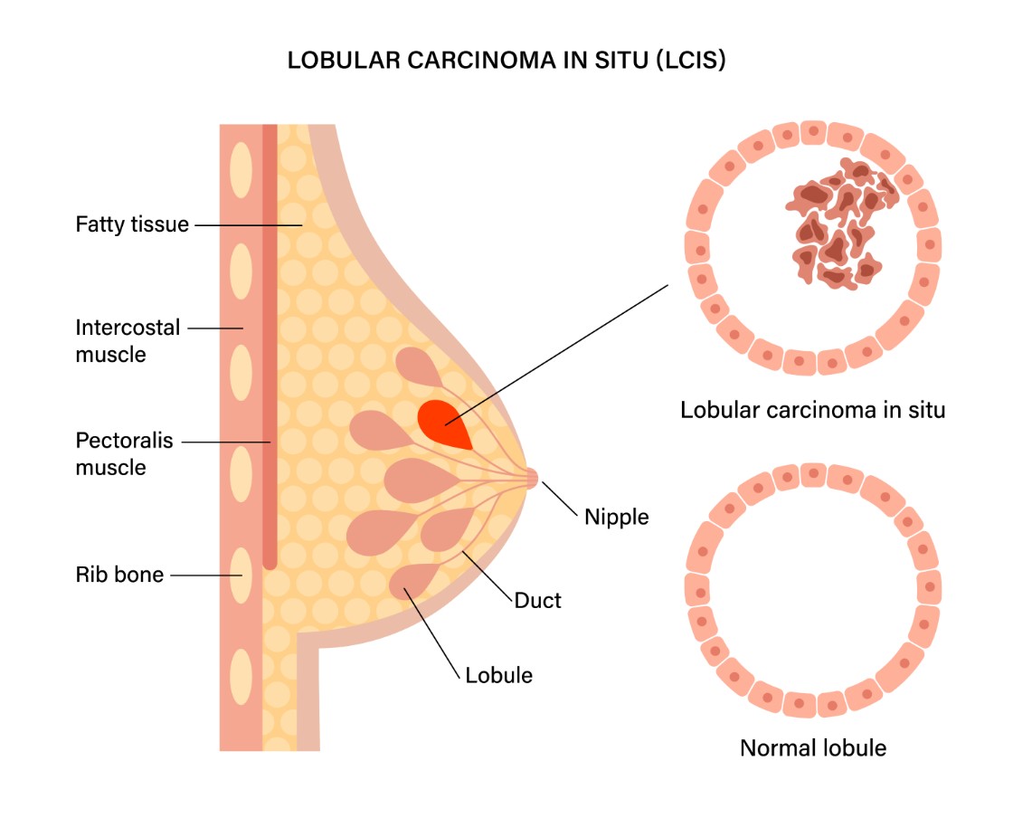 lobular breast cancer illustration