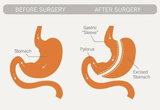 gastric sleeve illustration