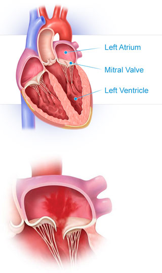 Diagram of the left atrium, mitrial valve,  and left ventrical of the heart 