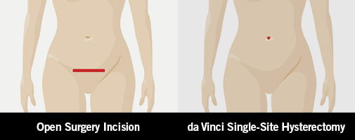 da Vinci Hysterectomy Surgery
