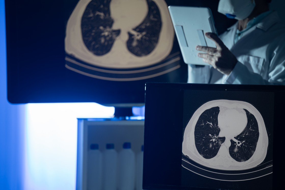 Low-Dose Computed Tomography (LDCT) scan of lungs