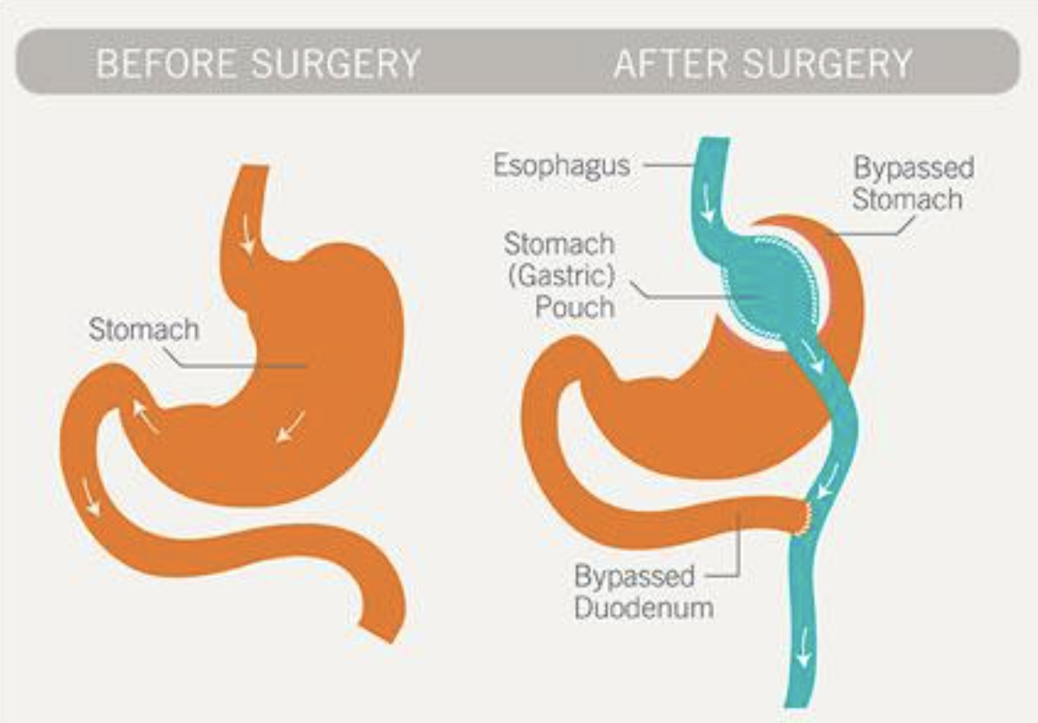 gastric bypass surgery infographic
