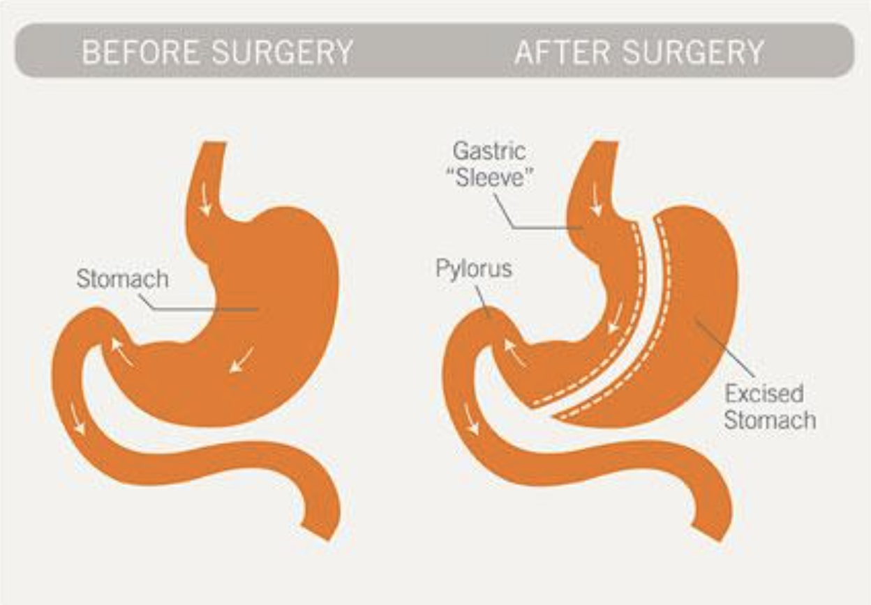 gastric sleeve surgery infographic