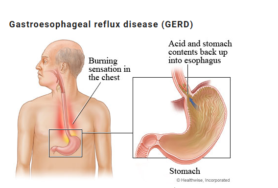 GERD