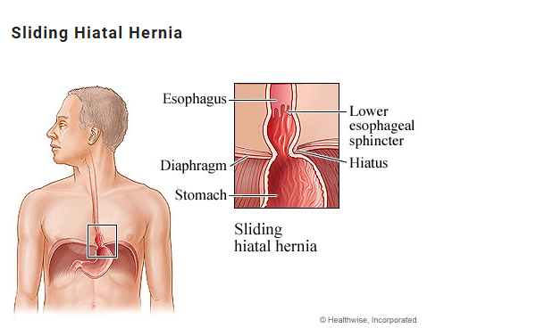 Sliding Hernia
